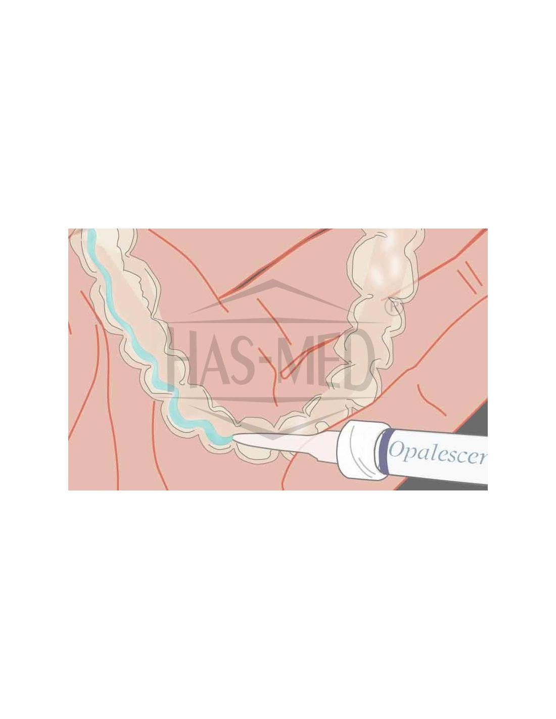 Opalescence PF 10% Żel do wybielania zębów