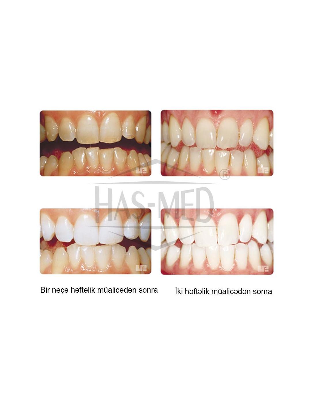 Opalescence PF 10% Żel do wybielania zębów